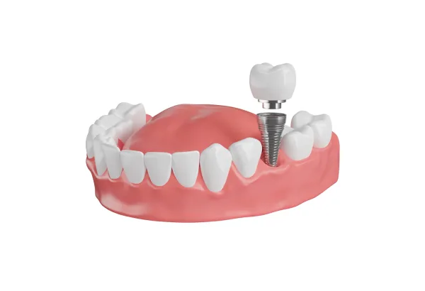 Dental Implant