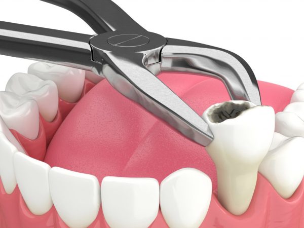 Laser-Assisted Surgical Extraction